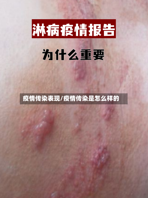 疫情传染表现/疫情传染是怎么样的-第1张图片